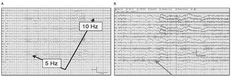 Normal Adult Eeg Thoracic Key