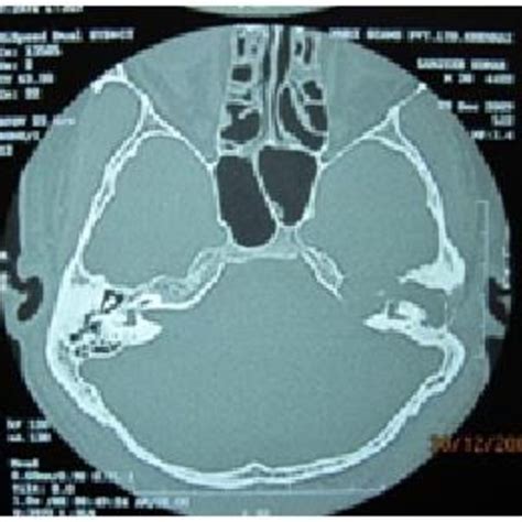 CT scan cholesteatoma involving the left internal auditory meatus ...