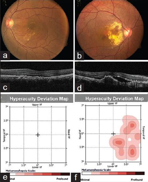 A B Fundus Photographs C D Optical Coherence Tomography OCT