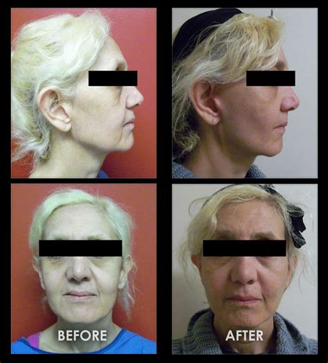 Cheek Sculpting Before And After Photos Increase Cheekbone Heighth