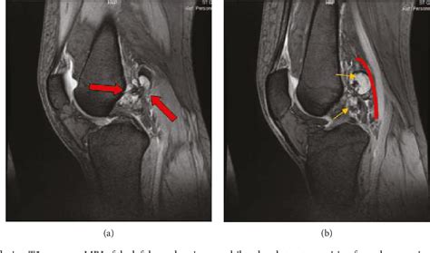 Figure 1 From Localized Pigmented Villonodular Synovitis Of The