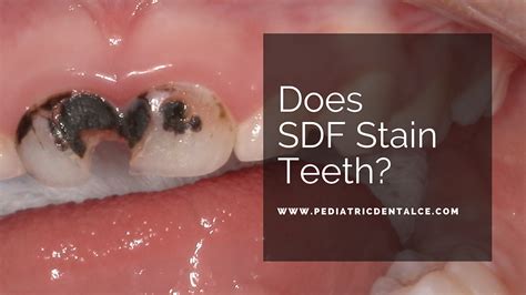 Does SDF stain teeth?