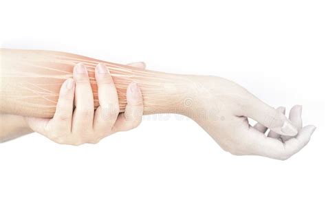 Forearm muscle injury stock photo. Image of nerve, retinaculum - 149789432