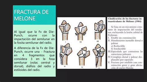 Tipos De Fracturas Distales Del Radiopptx