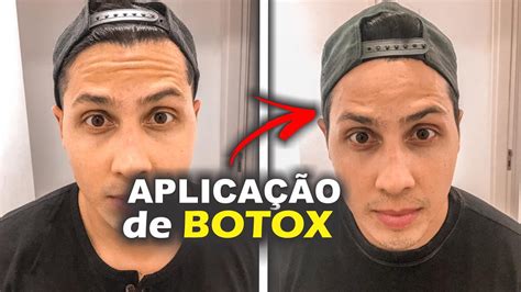 Botox Antes E Depois Quanto Custa Mudançafacialcompleta Ep4 Youtube