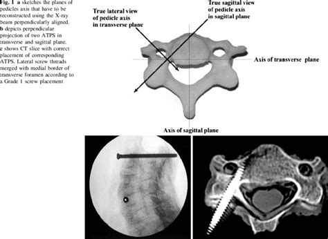 A Sketches The Planes Of Pedicles Axis That Have To Be Reconstructed