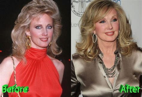 Morgan Fairchild Before And After Plastic Surgery Celebrity Plastic