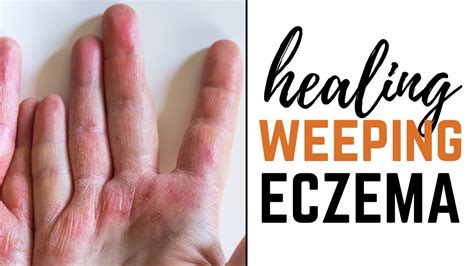 5 Natural Ways To Treat Weeping Eczema Youtube