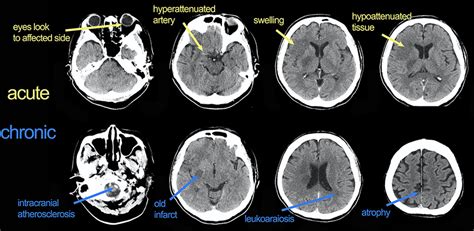 Imaging Advances Stroke