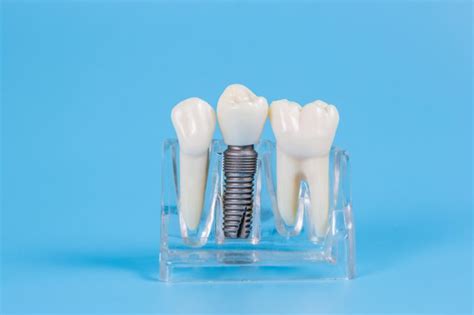 Riesgos De Los Implantes Dentales Centro Urgencias Dentales