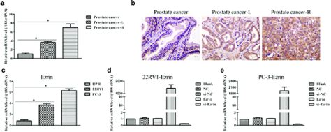 Expression Of Ezrin In Prostate Cancer Tissues And Cell Lines A The