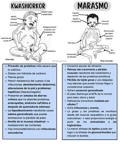 Diferencia Entre Kwashiorkor Y Marasmo Medi Fer UDocz