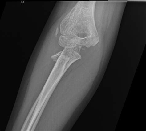 Radial Head And Neck Fractures Pediatric Pediatrics Orthobullets