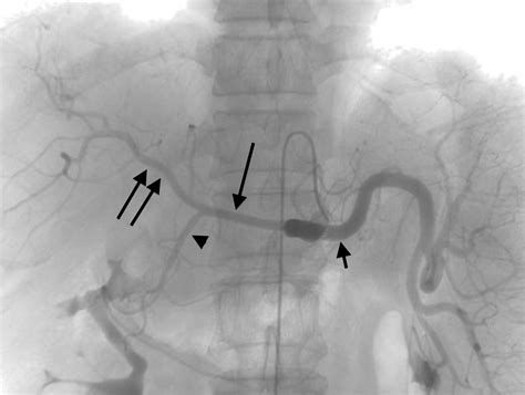 Mesenteric Ischemia Radiology Key