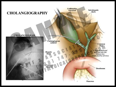 Cholangiography S A Medical Graphics