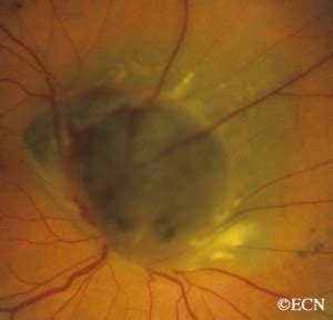 Choroidal Melanoma Of The Optic Nerve New York Eye Cancer Center