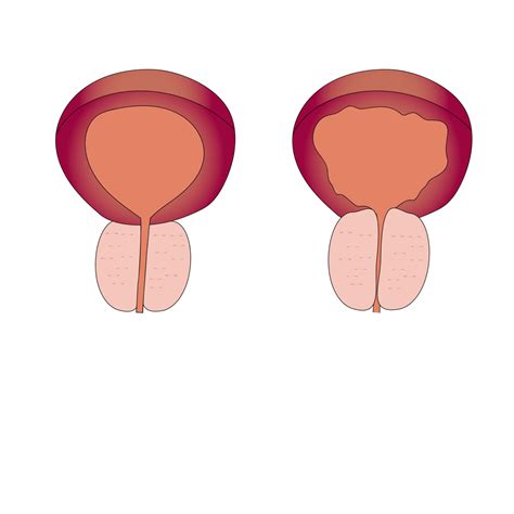 Hiperplasia Prost Tica Benigna Dr Raul Messias Urologista M Dico