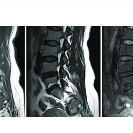 Primary Spinal Epithelioid Hemangioendothelioma Ehe In A