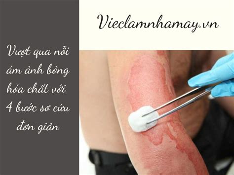 Vượt Qua Nỗi ám ảnh Bỏng Hóa Chất Với 4 Cách Sơ Cứu đơn Giản