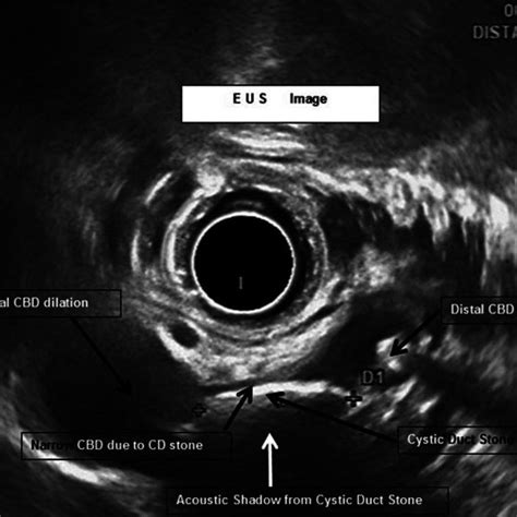 A Dilated Cystic Duct A And Dilated Cbd B Proximal To The