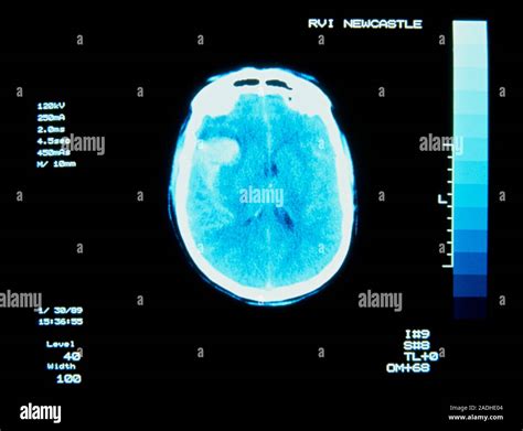 Rayos X Tomografía Computarizada Tac Del Cerebro Mostrando Una