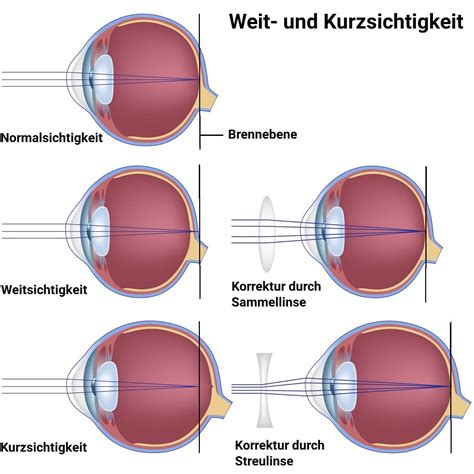 Weitsichtigkeit Unscharfes Sehen Bei Nahen Objekten Aumedo