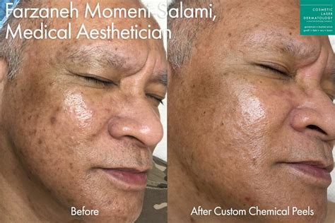 Deep Chemical Peel Before And After Purchase Pinnaxis