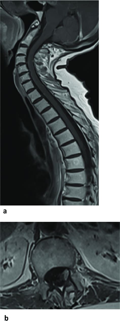 A Sagittal T1 Post Gadolinium Image Of The Spine Demonstrates Fine