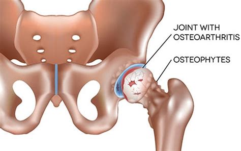 Osteophyte Bone Spur Causes Symptoms And Treatment