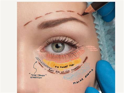 Custom Cosmetic Blepharoplasty of the Lower Lids