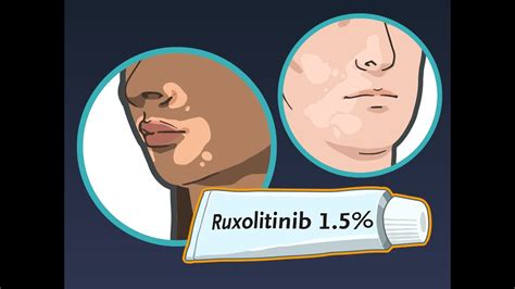 Ruxolitinib Cream For Vitiligo Nejm Youtube