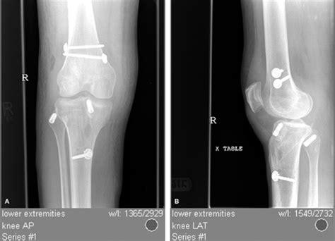 Meniscal Allograft Transplantation Musculoskeletal Key