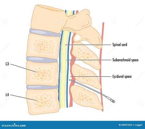 Catheter in epidural space stock vector. Illustration of health - 60927024