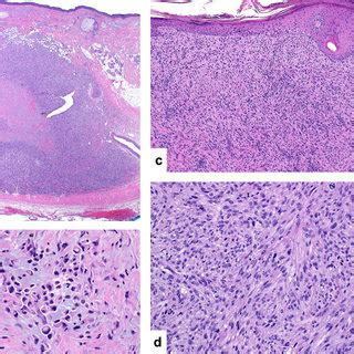 Spindle Cell Squamous Cell Carcinoma This Nodular Tumor Is Centered