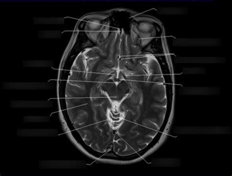 Axial Head Mri Scan