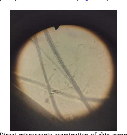 Figure From Successful Management Of Dermatophytosis In A Desi Short