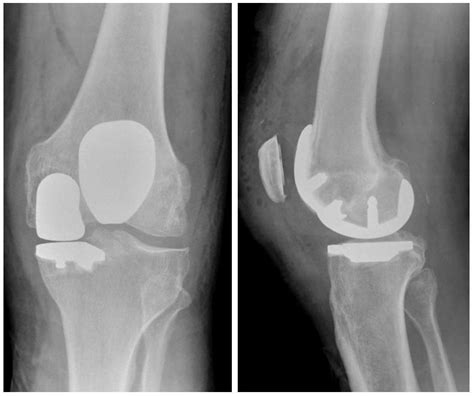 Is Makoplasty Partial Knee Replacement Right For You