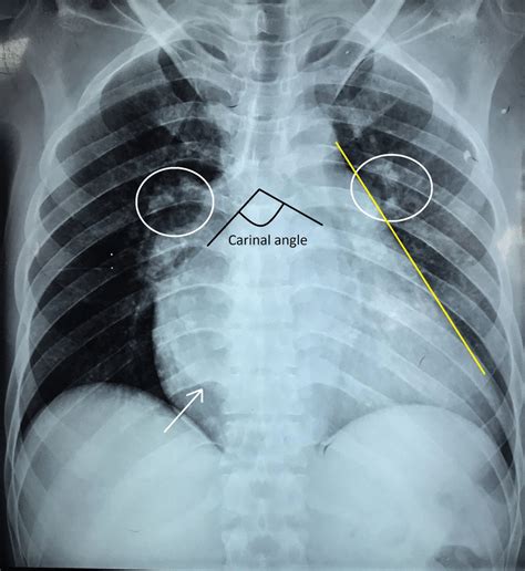 Chest X Ray Of The Heart