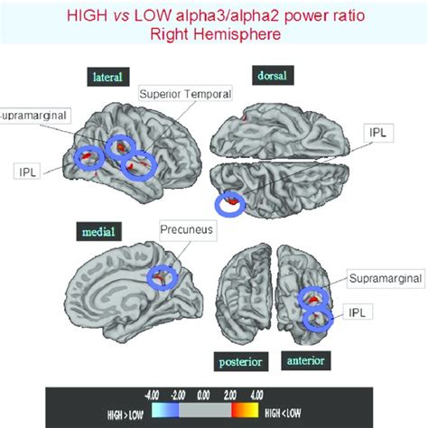 Brain Regions With Significant Regional Cortical Thickness Differences