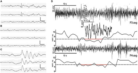 Frontiers Electrophysiological Biomarkers Of Epileptogenicity In