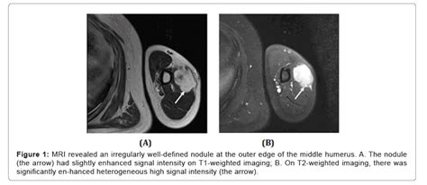 Diagnostic Pathology Open Access Large Size Intramuscular Nodular Fasciitis A Challenging