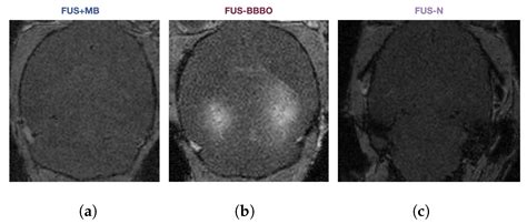 Focused Ultrasound Mediated Bloodbrain Barrier Opening Best Promotes