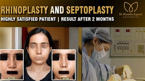 Rhinoplasty Nose Job Delhi India By Dr Monisha Kapoor YouTube