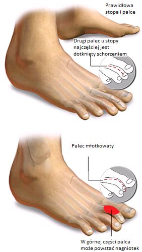 Palec M Otkowaty Operacja Leczenie W Krakowie Foot Med Pl