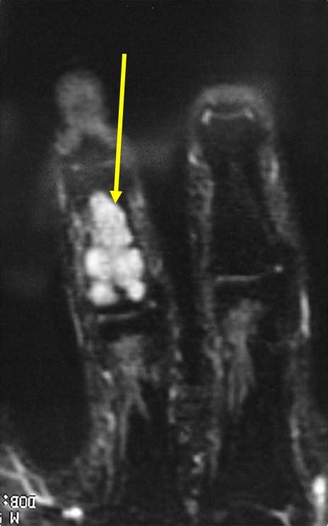 Enchondroma Benign Bone Tumor Tumors Of Bone