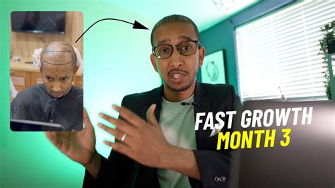 Month 3 Update Insane Growth FUE Hair Transplant Results From Turkey