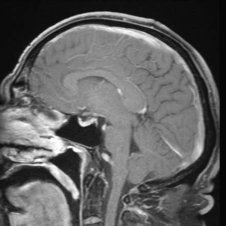 Solitary Fibrous Tumor Hemangiopericytoma Image Radiopaedia Org