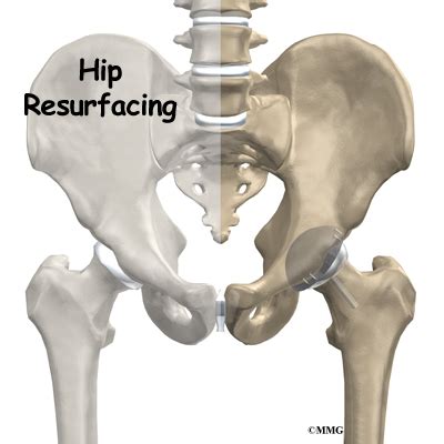 Hip Resurfacing Arthroplasty - Orthopedic Surgery, Algonquin, IL ...