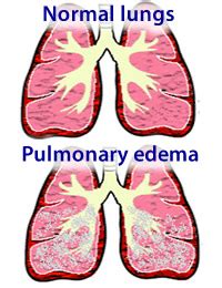 Prepare for Medical Exams : Regarding Acute Pulmonary Edema