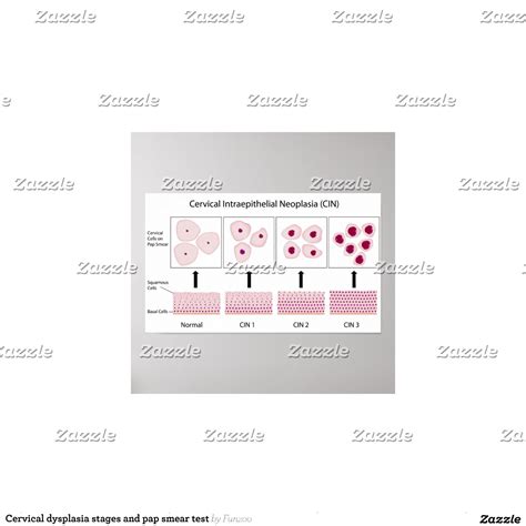 Cervical Dysplasia Stages And Pap Smear Test Zazzle